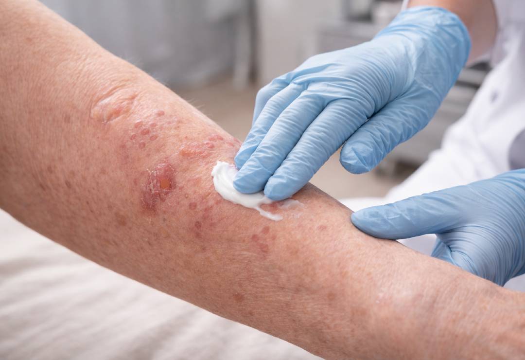 Büllöz Pemfigoid Tedavisi