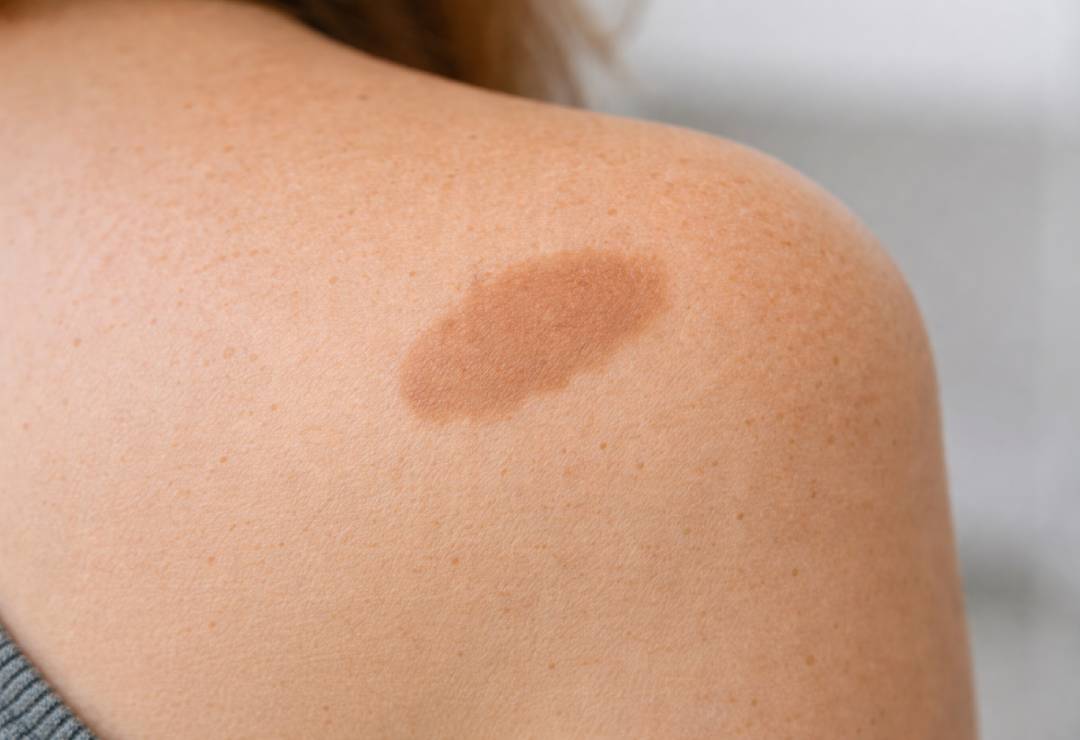 Doğum Lekesi Tedavisi