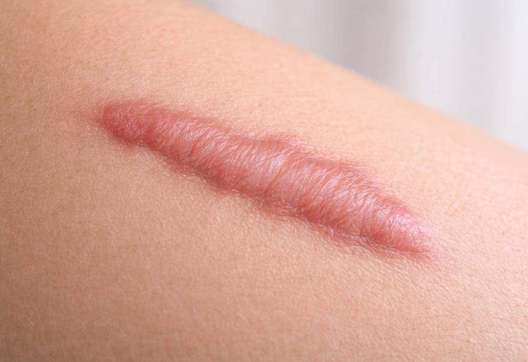 Keloid Yara İzi Tedavisi