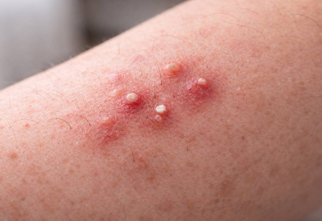 Kıl Kökü İltihabı