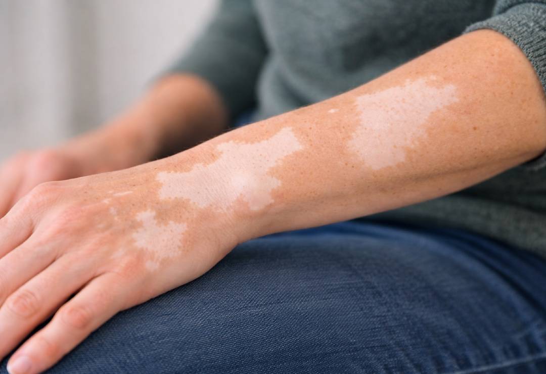 Vitiligo Tedavisi